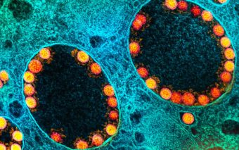 Variante do Covid-19 causa primeira morte; uma mulher de 77 anos