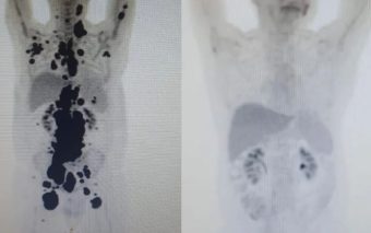 Descoberta revolucionária no combate ao câncer: Paciente com câncer há 13 anos alcança remissão com terapia celular em SP