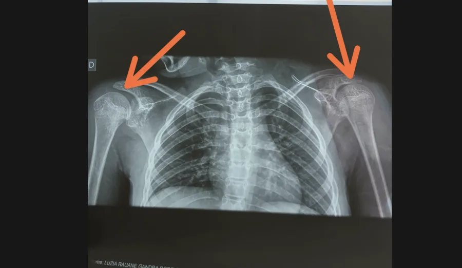 Arquivo mostra RX bilateral com marcações visuais da família para destacar a região dos ombros. A reportagem não emite diagnóstico; o exame é apresentado como elemento de contexto clínico posterior ao transporte.