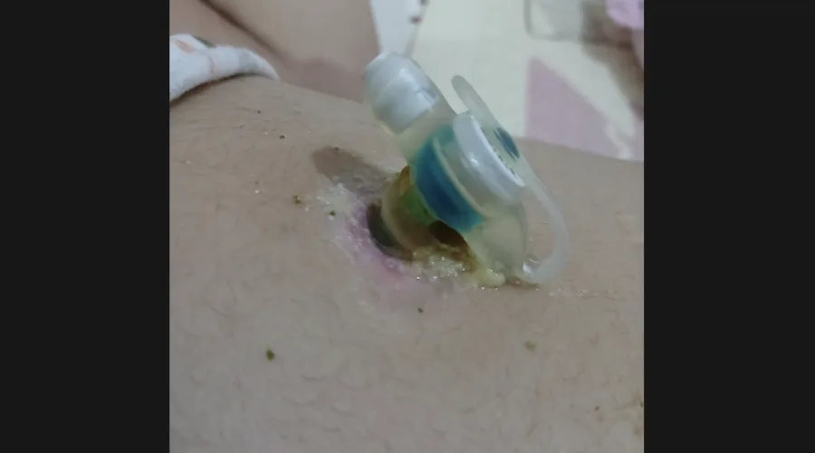 Registro fotográfico evidencia hiperemia e secreção ao redor do botão. Trata-se de material sensível, publicado apenas com tarja/blur e aviso de conteúdo, preservando a criança.