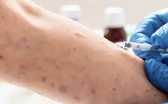 Mpox: Santos confirma 2 casos e SP chega a 44 registros em 2026, reacendendo alerta sanitário