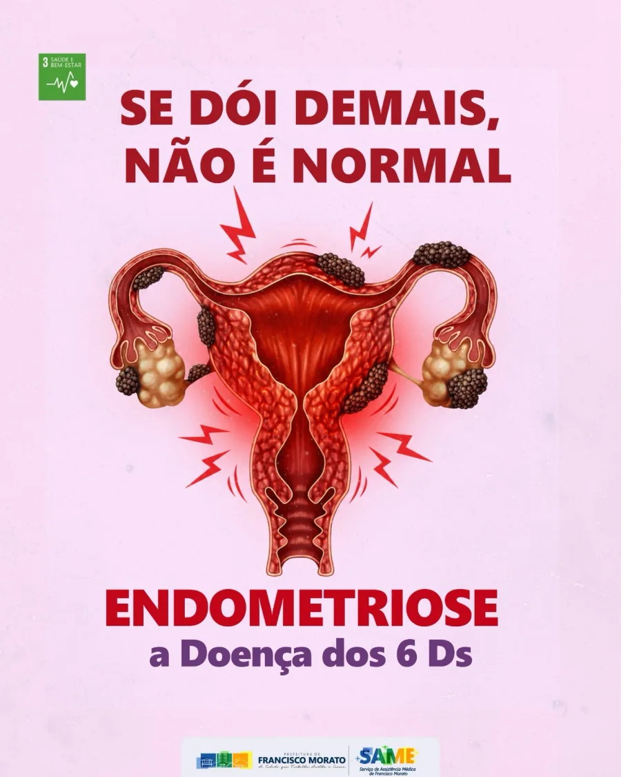 A campanha também chamou atenção para os chamados “6 Ds da endometriose”, grupo de sintomas frequentemente associados à doença. Segundo a prefeitura, o objetivo é incentivar mulheres a buscarem atendimento médico ao perceber dores intensas ou alterações recorrentes no organismo.