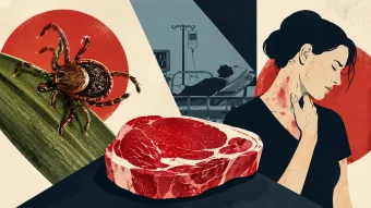 Síndrome alfa-gal: Picada silenciosa de carrapato pode causar alergia grave à carne vermelha e médicos alertam para avanço dos casos