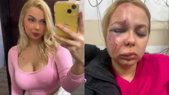 Agressão no Metrô de SP: mulher teve maxilar, nariz e joelho quebrados após ataque na estação Parada Inglesa