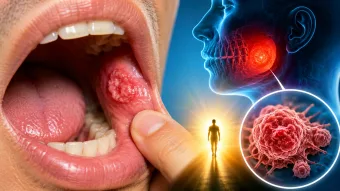 Uma simples informação pode fazer diferença no diagnóstico precoce; evento em Mairiporã aborda prevenção ao câncer bucal
