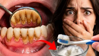Receitas caseiras não removem tártaro endurecido e podem aumentar danos aos dentes